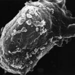 Scanning electron microscope image of a lymphocyte with HIV cluster