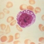 Enlarged Lymphocyte caused by Hantavirus Pulmonary Syndrome