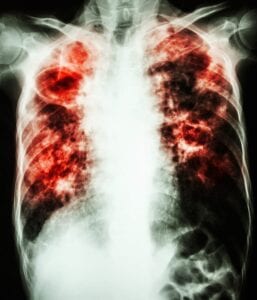 Deadly Tuberculosis in Lungs