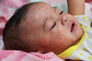 A 2014 case of infant measles in the Philippines. Credit: Rebecca Martin/CDC