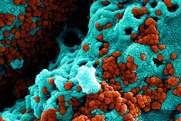Health Officials Confirm Second Case of Coronavirus in Bay Area