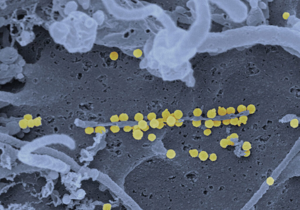 High-resolution electron micrograph showing dozens of small, round Crimean-Congo hemorrhagic fever virus particles budding from the uneven surface of human epithelial cells. The virus particles appear clustered along thin, thread-like cellular extensions, giving the impression of beads strung along twisted biological filaments.