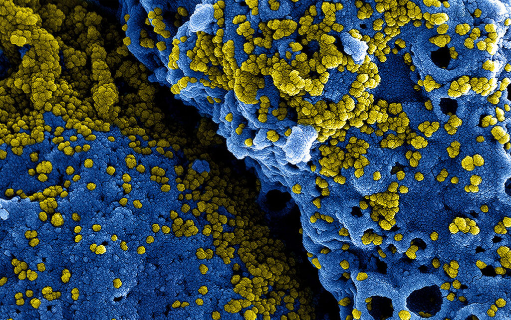 High-magnification scanning electron microscope image showing numerous Middle East Respiratory Syndrome (MERS) coronavirus particles densely clustered on the surface of a cultured human-like cell. The virus particles are small, round structures protruding from and adhering to the uneven cell surface, illustrating an active stage of viral infection where the virus is replicating and budding from the host cell. This image captures the physical interaction between virus and host, highlighting the cellular damage and viral load typical in severe coronavirus infections.