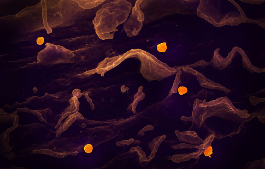 Kerala Records Another Nipah Virus Case as India’s Endemic Hotspot Faces Recurring Spillover Risk A scanning electron microscope image shows Nipah virus particles budding from cellular surfaces. Thread-like viral filaments extend across the image, with individual spherical virus particles highlighted in distinct prominence. The budding process shows the virus emerging from and attached to the infected cell membrane. The image captures the characteristic morphology of Nipah virus at high magnification against a dark background.