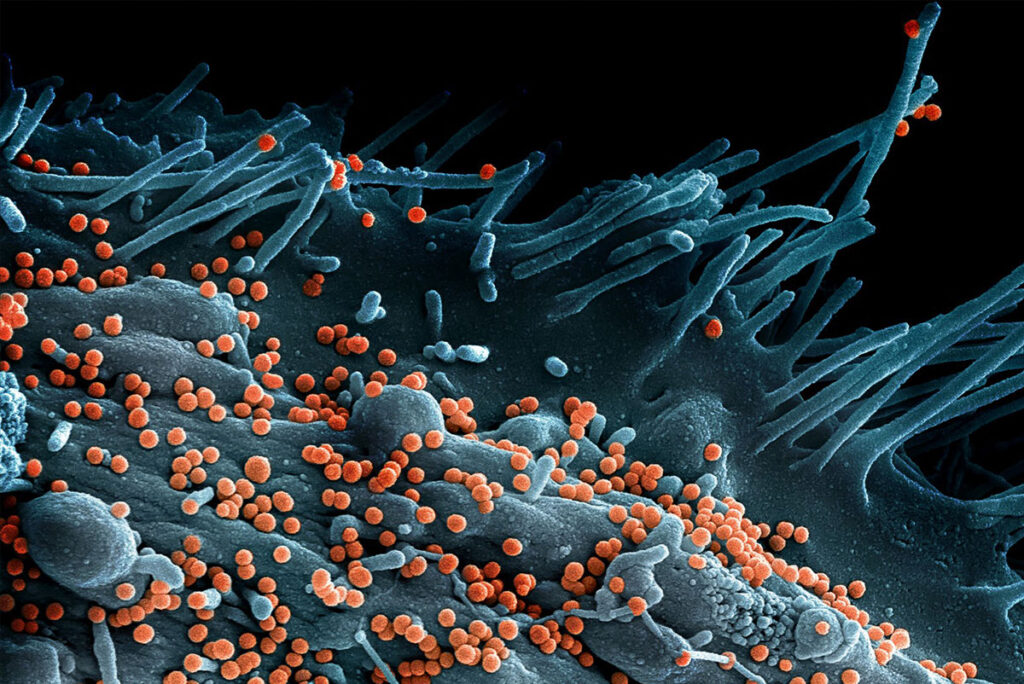 Experimental Two-in-One Vaccine Shows Early Promise Against Lassa Fever and Rabies A scanning electron microscope image shows numerous spherical viral particles budding from cellular surfaces. The particles are densely packed across the tissue, with thread-like cellular structures extending through the frame. The infected tissue displays rough, irregular surface patterns with viral particles emerging and accumulating across various sites. The image captures the dense viral replication typical of hemorrhagic fever infections