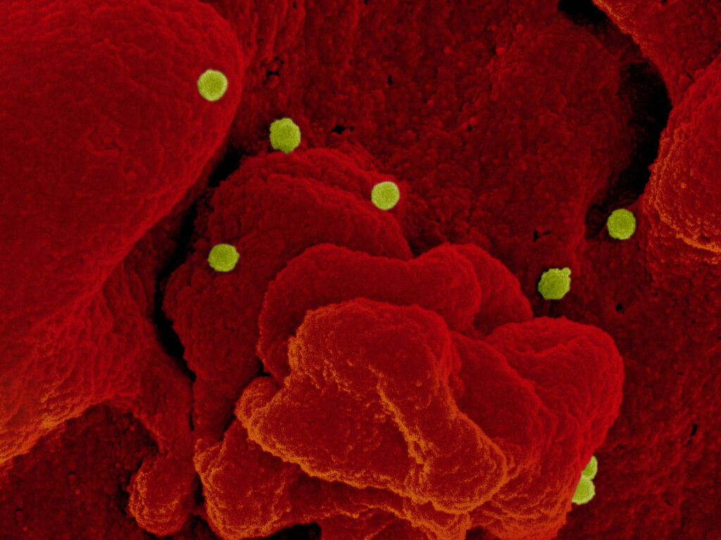 Crimean-Congo Hemorrhagic Fever Strikes Uganda’s West Nile Region, Killing a Child and Raising Surveillance Concerns A colorized scanning electron micrograph shows the textured, folded surface of clustered cells, with several small round particles scattered across and between the cell surfaces, some appearing at the edges where they emerge from the cell membrane.