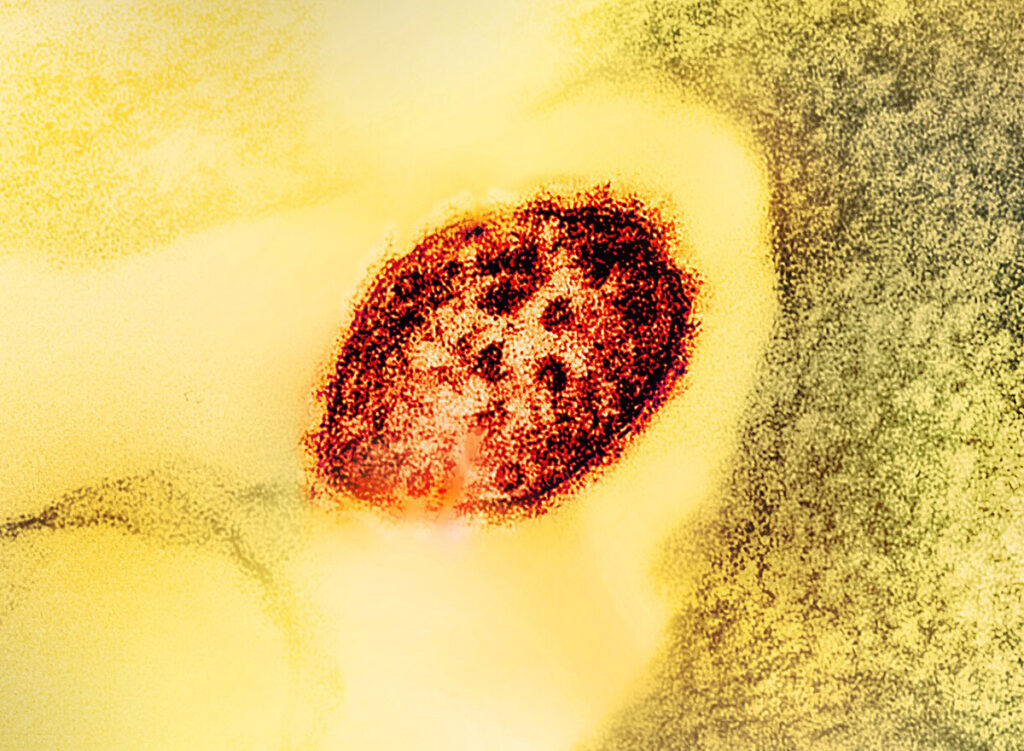 Romania’s Measles Epidemic: Vaccine Hesitancy Meets a Health System That Stopped Reaching Families A transmission electron microscope image showing a single measles virus particle at high magnification. The virion displays a spherical structure with visible surface detail and internal ultrastructure. The particle is centered against a granular background showing the cellular environment or medium in which it is suspended.